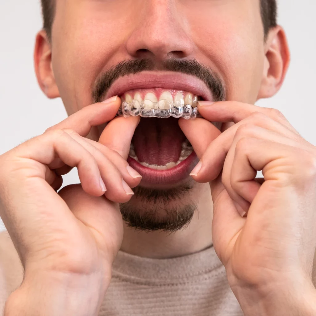 man putting on clear aligners | best clear aligners dentist near you
