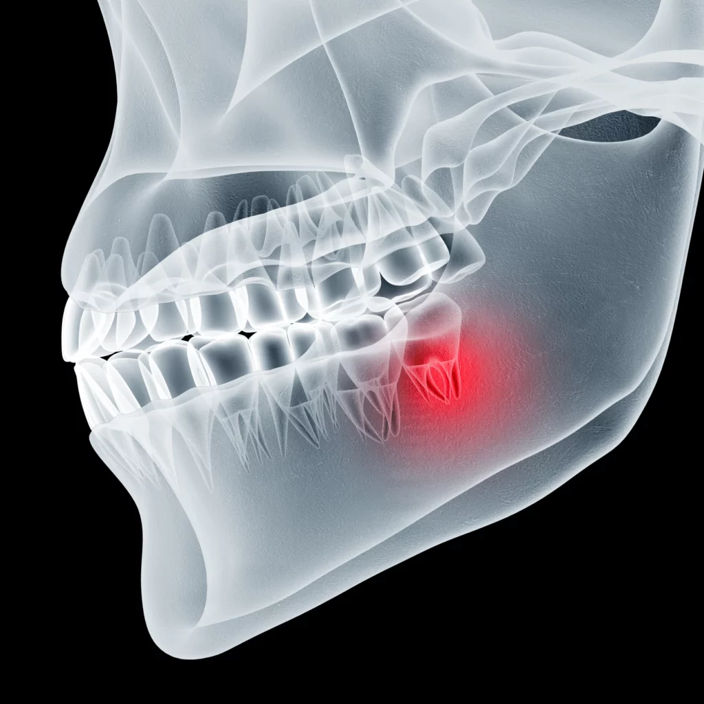 wisdom teeth removal in Conroe, TX