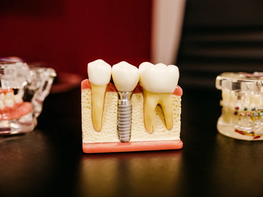 model of a single tooth dental implant | cost of dental implants in Conroe, TX