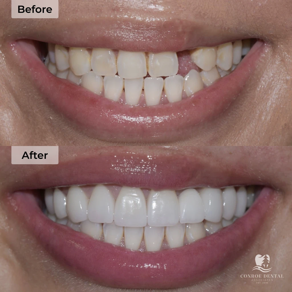 before and after dental implants