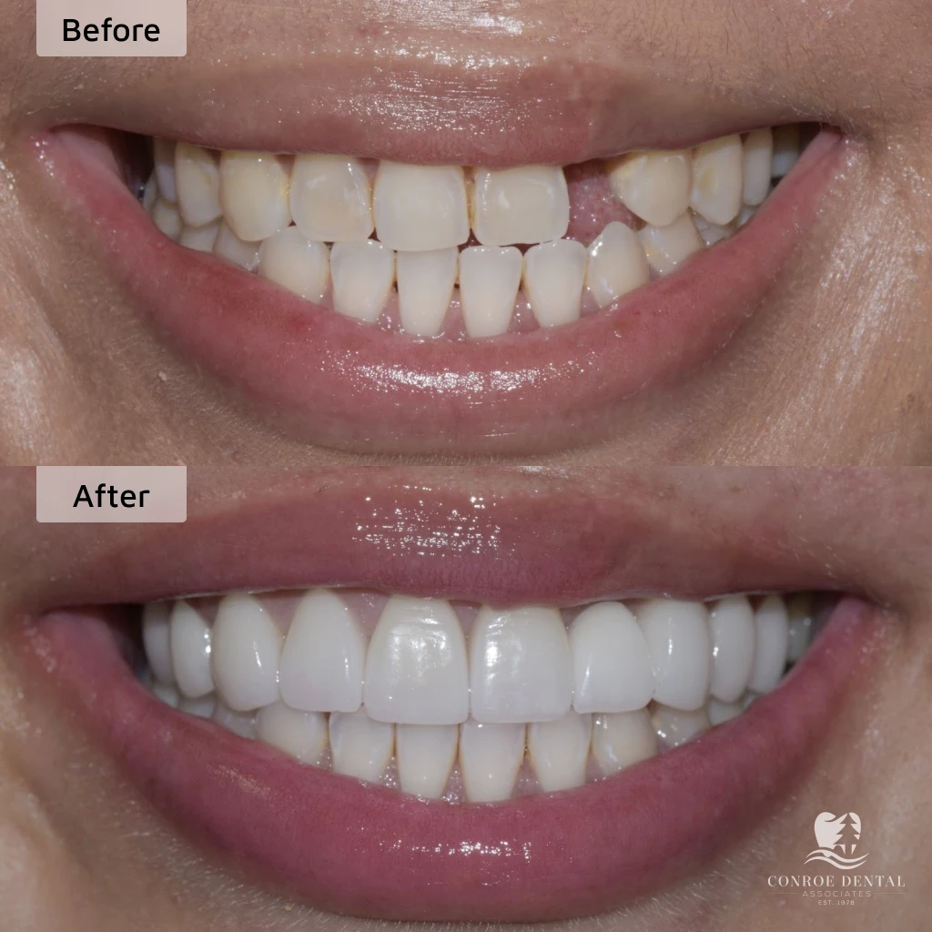 before and after dental implants in Conroe, TX at Conroe Dental Associates