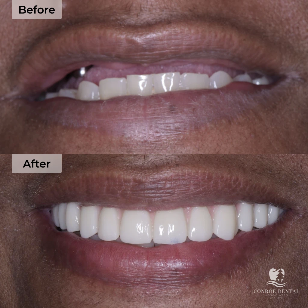 before and after dental implants