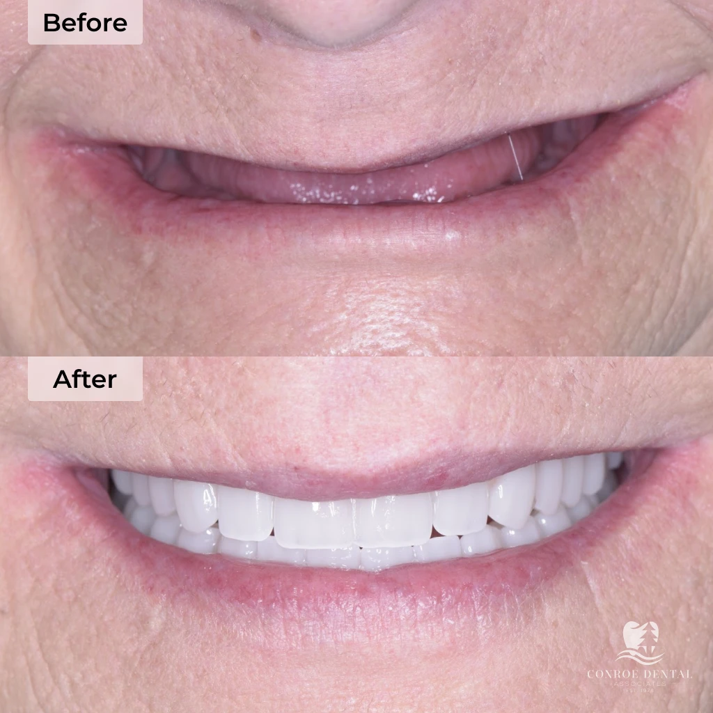 before and after dental implants