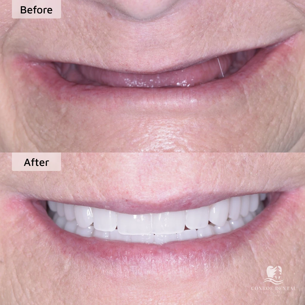 before and after dental implants in Conroe, TX at Conroe Dental Associates