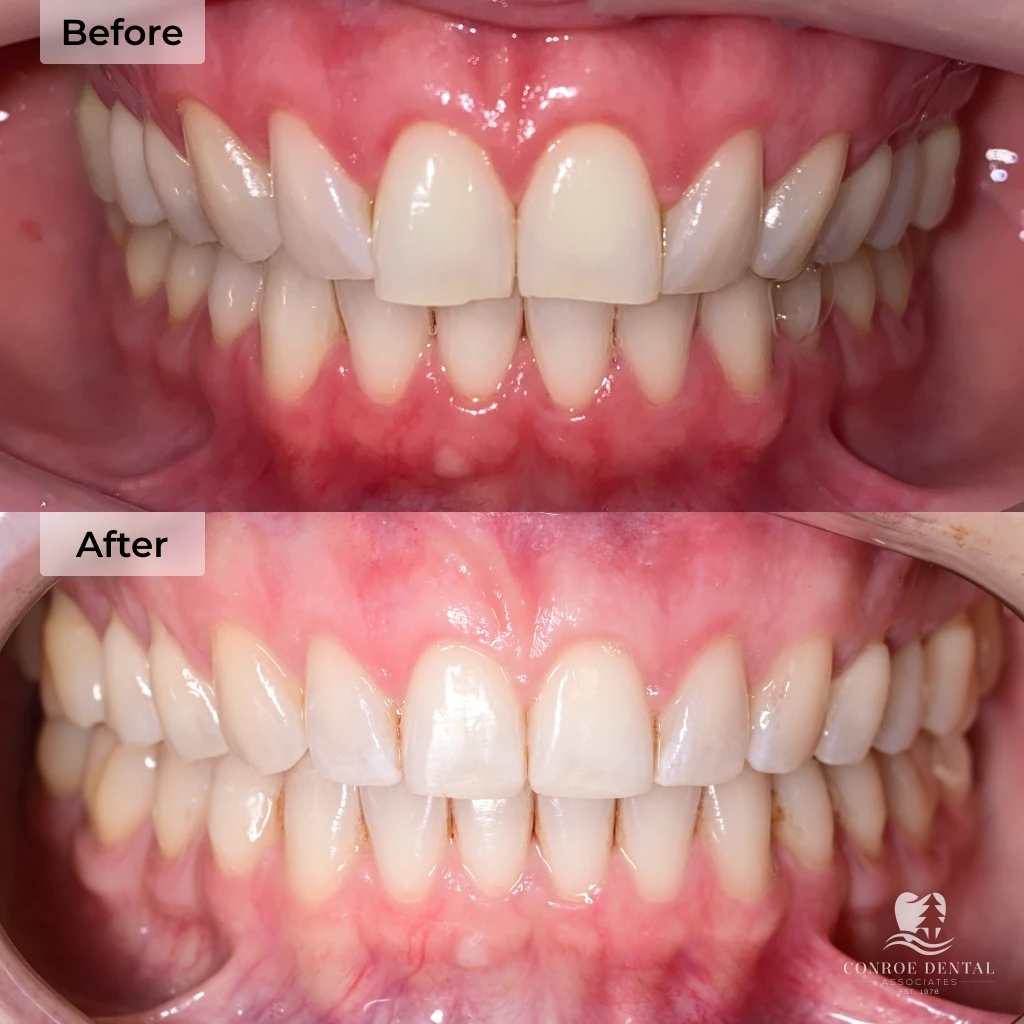 before and after clear aligner treatment at Conroe Dental Associates