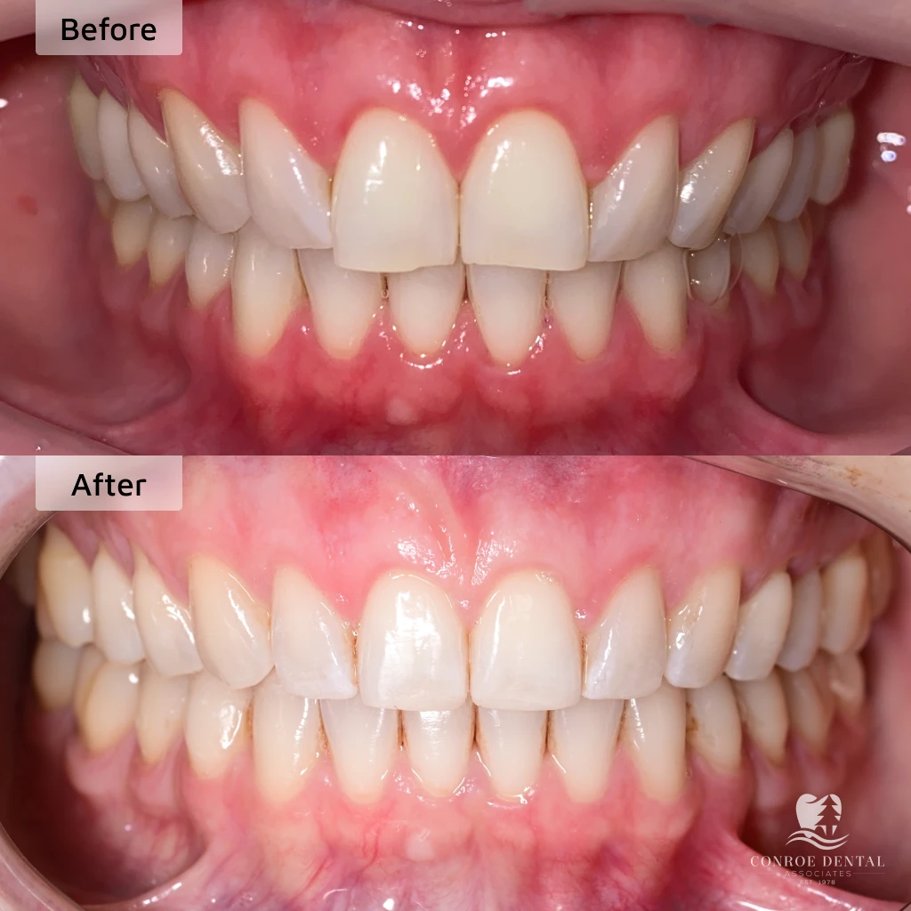 before and after clear aligner treatment at Conroe Dental Associates