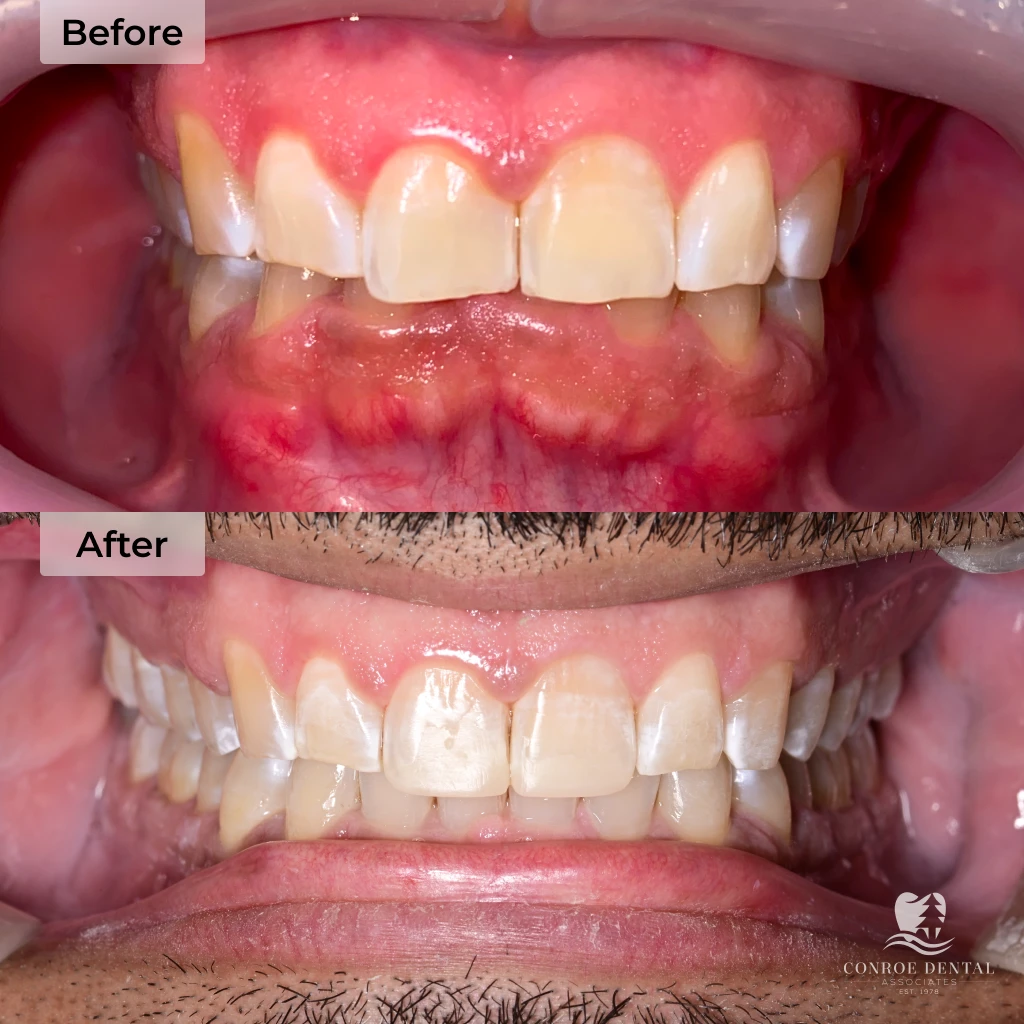 before and after clear aligner treatment at Conroe Dental Associates