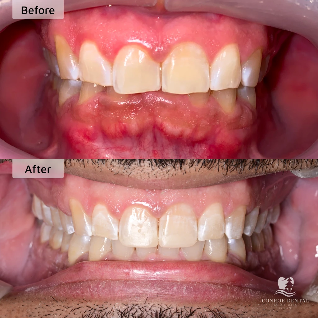 before and after clear aligner treatment at Conroe Dental Associates