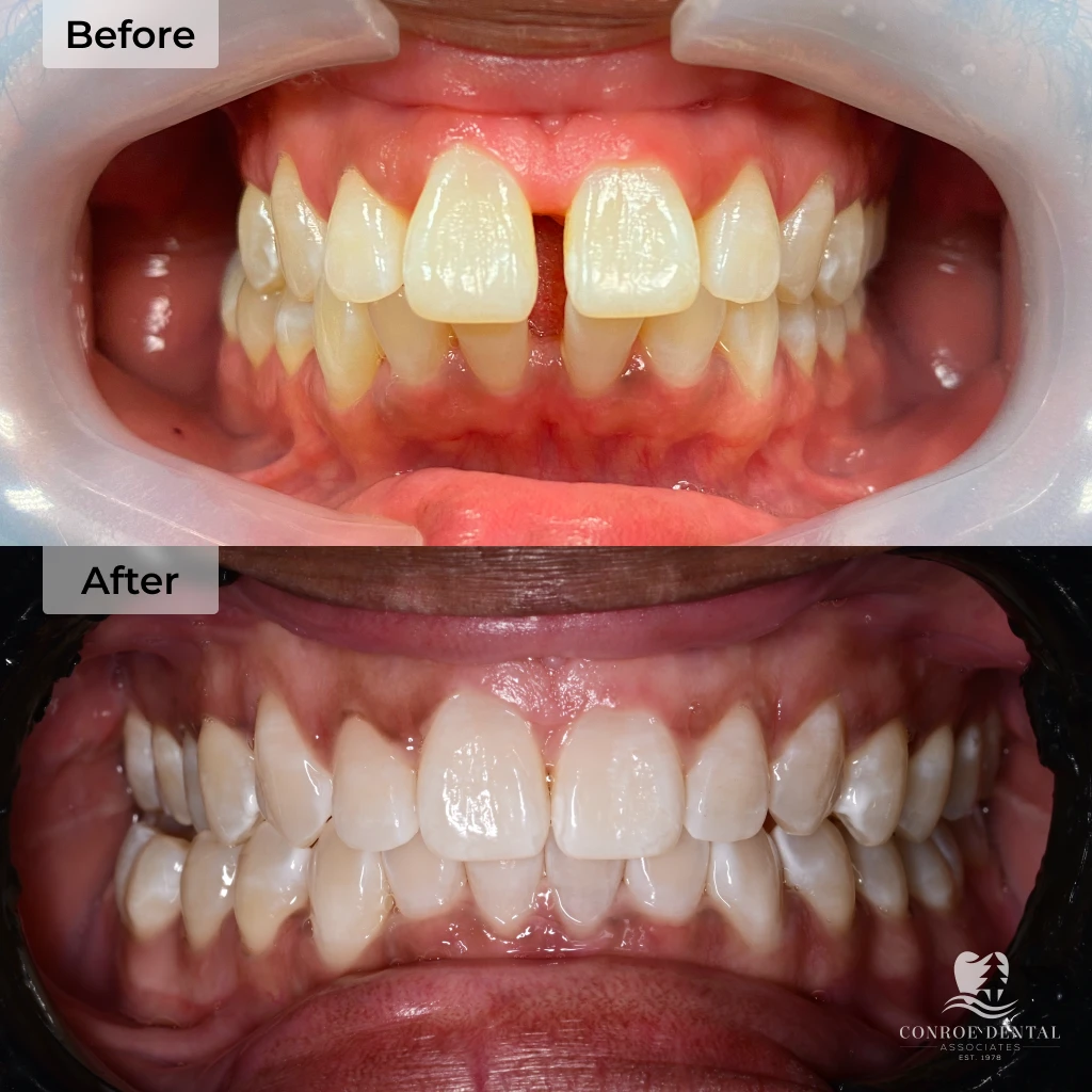 before and after clear aligner treatment at Conroe Dental Associates